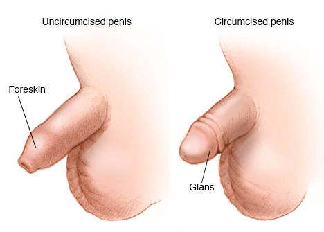 glans with and without foreskin